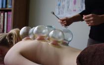 What is hijama: reviews, contraindications